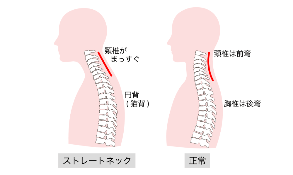 ストレートネックと正常の首の比較
